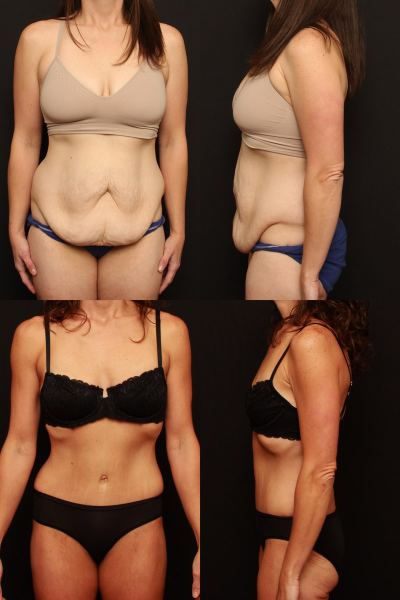 Tummy Tuck - American Academy of Cosmetic Surgery